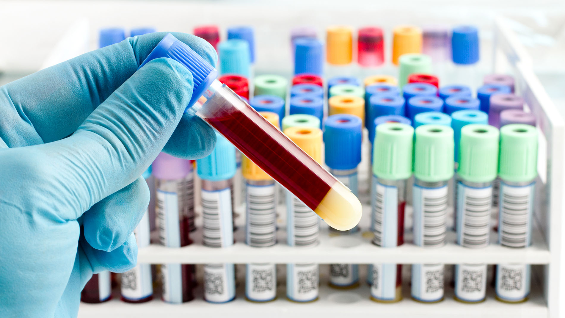Explained: What is antibody test for COVID-19 and why is it important?