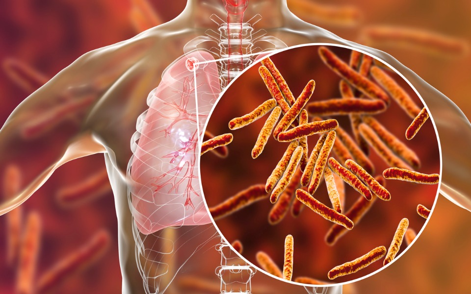 Study provides new insights into drug-resistant tuberculosis