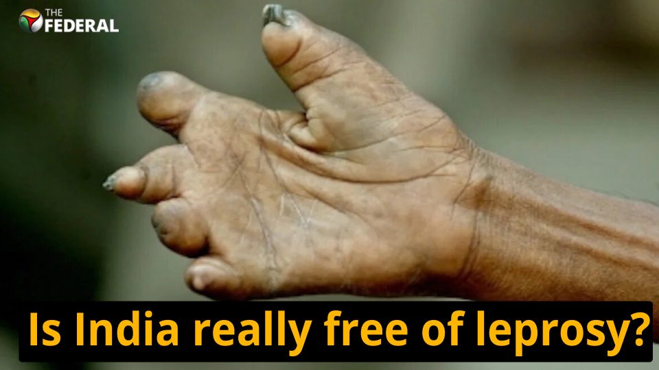 India home to more than half of world’s leprosy patients
