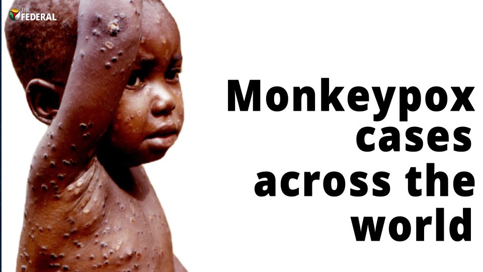 Rise in Monkeypox cases raises alarm