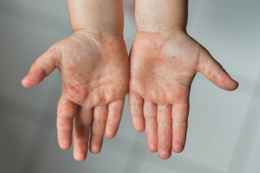 What is monkeypox?