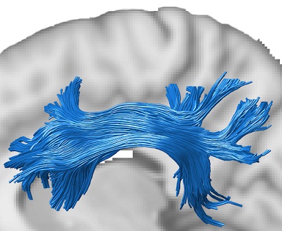 Superior longitudinal fasciculus