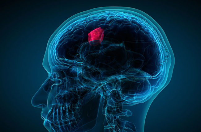 Brain tumour could now be detected using urine test