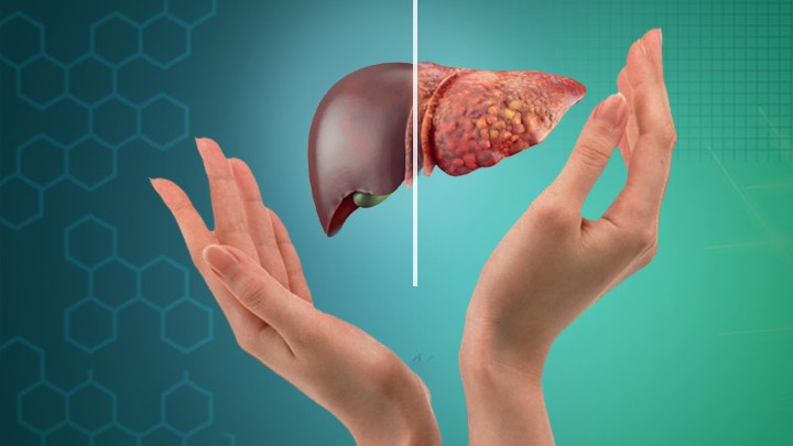 Heres how you can prevent non-alcoholic fatty liver disease
