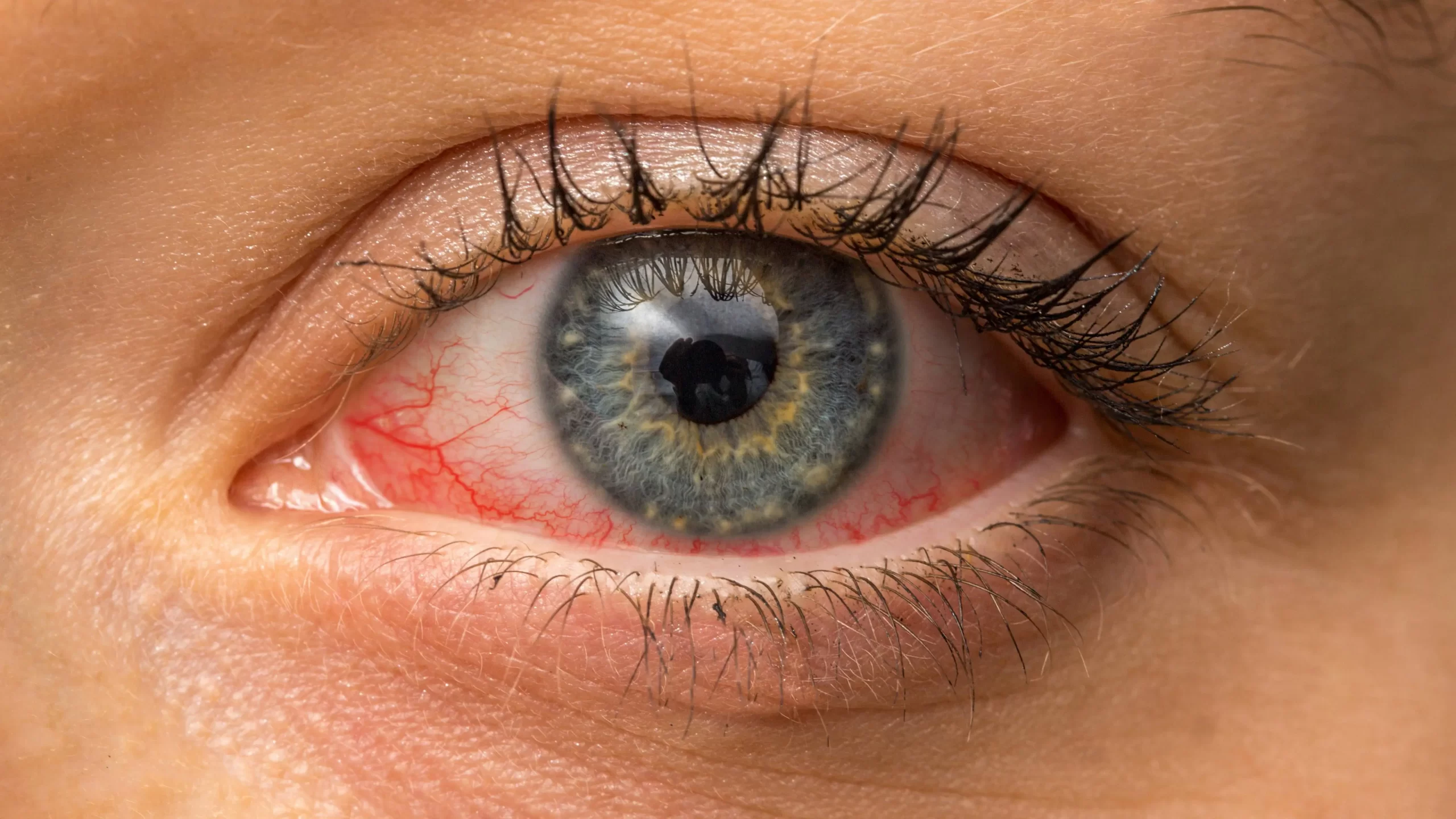 Amid conjunctivitis, eye flu, doctors warn against steroid eye drops