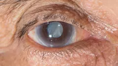 Gujarat: 17 patients complain of vision loss after cataract surgery; probe ordered
