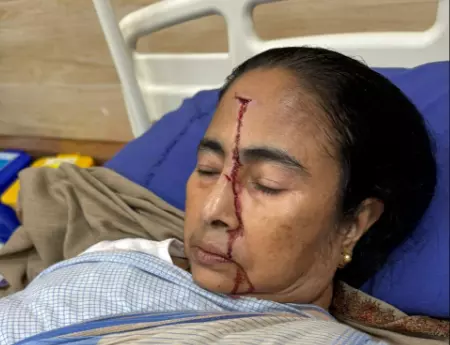 Mamata’s fall: Hospital’s ‘push from behind’ claim sparks speculations