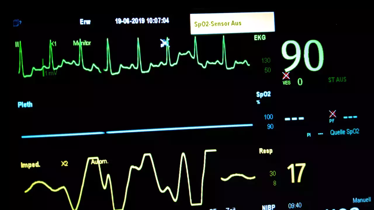 ECG