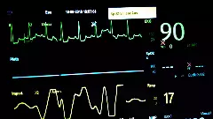 ECG