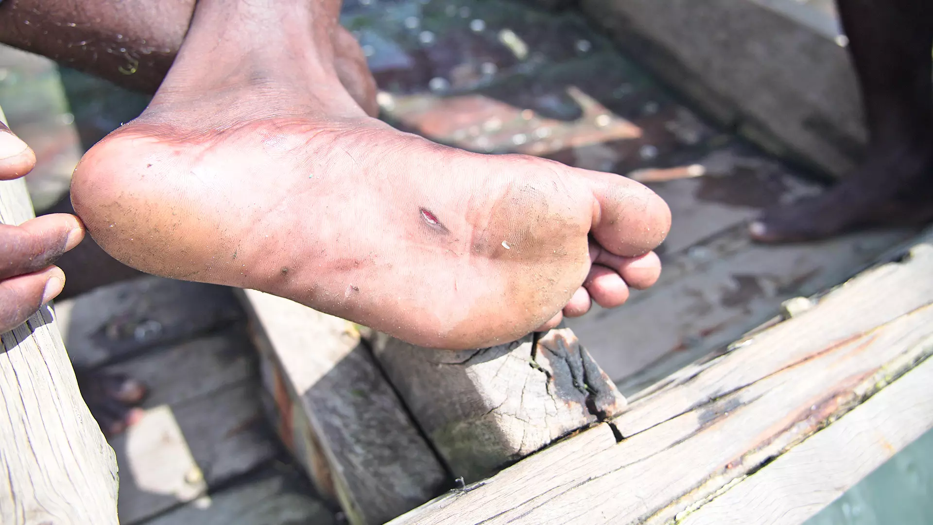 Fisherman A. Basker shows his bruised foot. Photos: Karunakaran B 