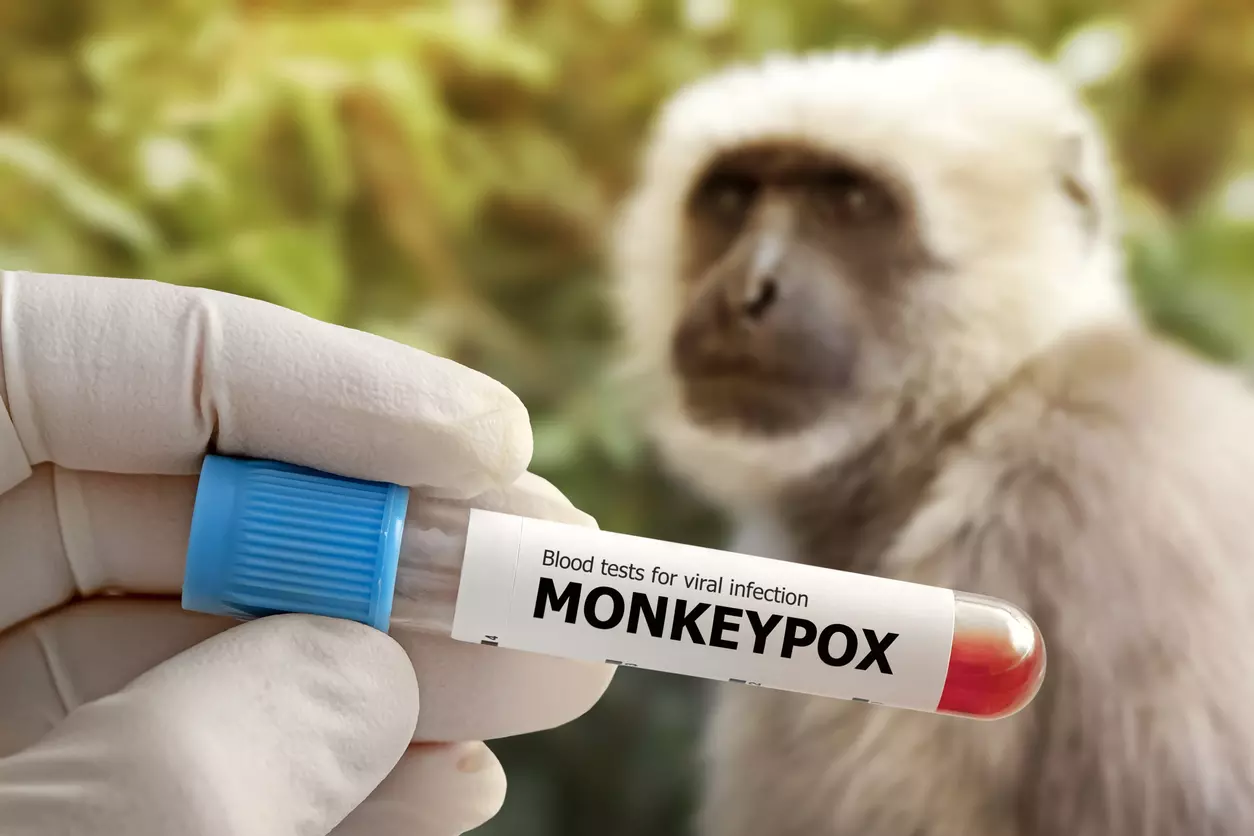 Monkeypox alert issued by Kerala amid global reports of viral infection