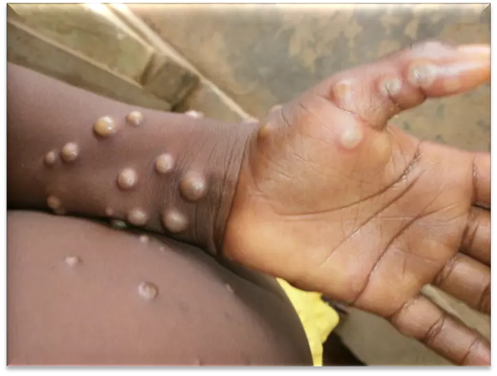 Man with suspected Mpox symptoms isolated; Centre issues advisory to states Man with suspected Mpox symptoms isolated; Centre issues advisory to states
