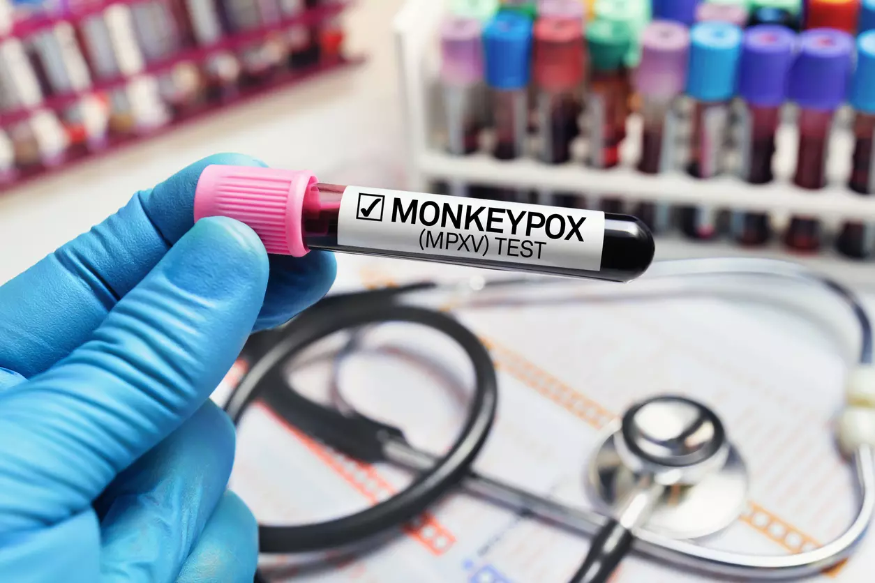 What is Monkeypox? Could it be the next COVID?