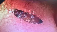 Live 3 cm cockroach removed from mans intestine in Delhi