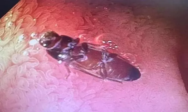 Live 3 cm cockroach removed from mans intestine in Delhi