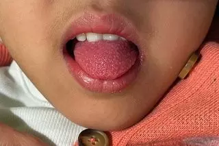 Scarlet fever cases on rise in Hyderabad among children