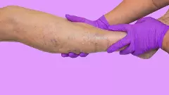 Lower limb vascular examination